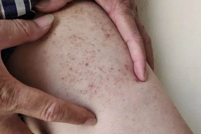 Cukrzyca u dzieci objawy skórne – jak rozpoznać niepokojące zmiany