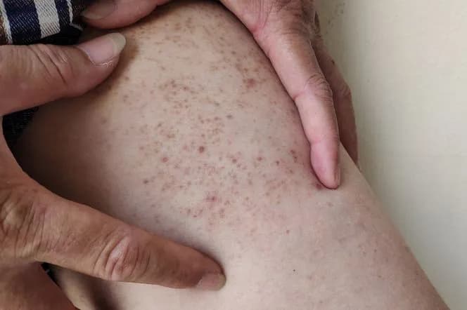 Cukrzyca u dzieci objawy skórne – jak rozpoznać niepokojące zmiany