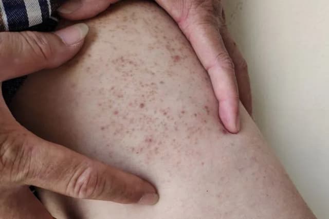 Cukrzyca u dzieci objawy skórne – jak rozpoznać niepokojące zmiany