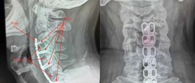 Dyskopatia szyjna C6-C7 objawy: Co powinieneś wiedzieć o bólu szyi