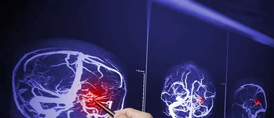 Jak odróżnić nerwicę od guza mózgu - objawy, które musisz znać