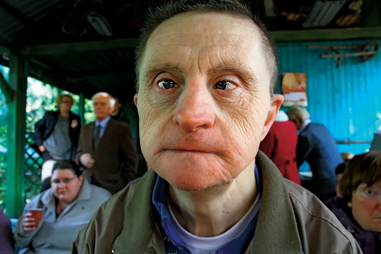 Jak długo żyją osoby z zespołem Downa? Zaskakujące statystyki życia